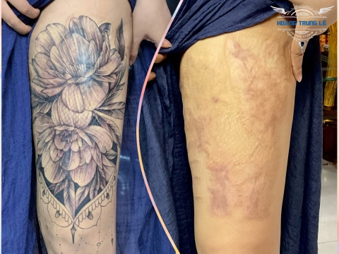 Nghệ thuật hình xăm che sẹo mổ: Khôi phục vẻ đẹp 